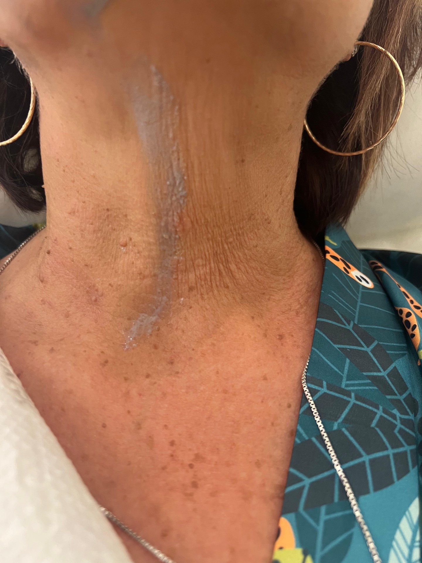Neck skin tightening treatment
