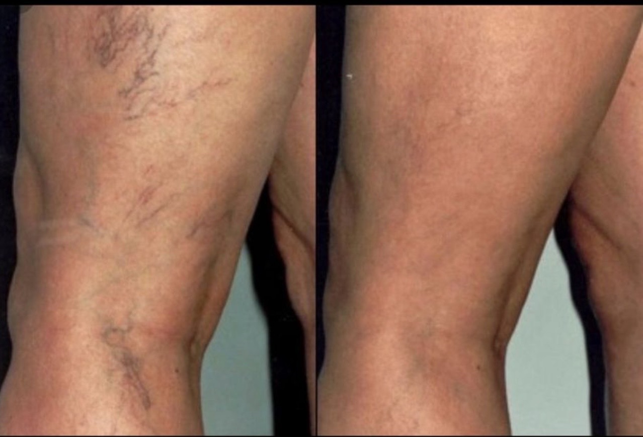Leg vein reduction before and after