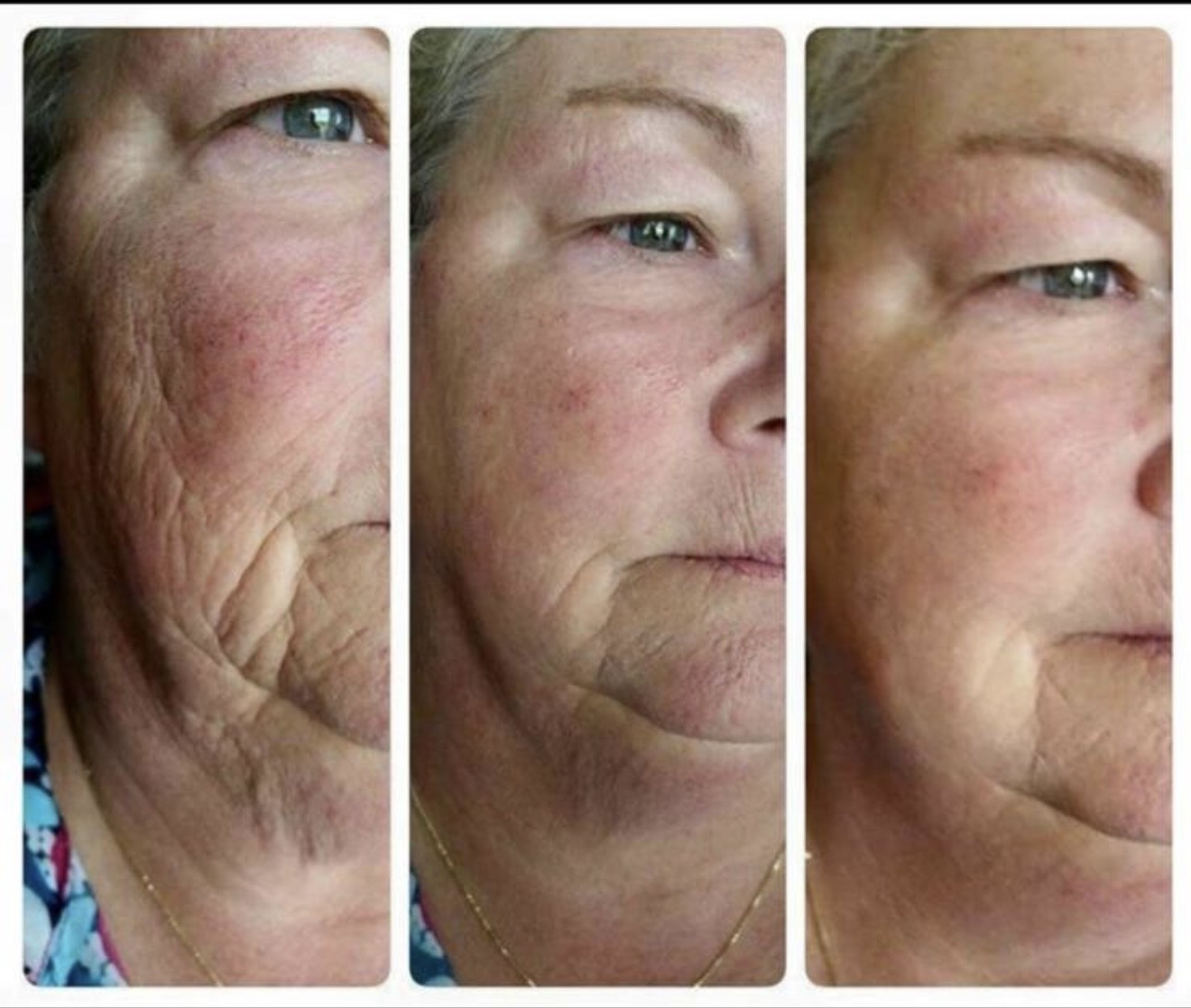 Face lift and wrinkle reduction progression