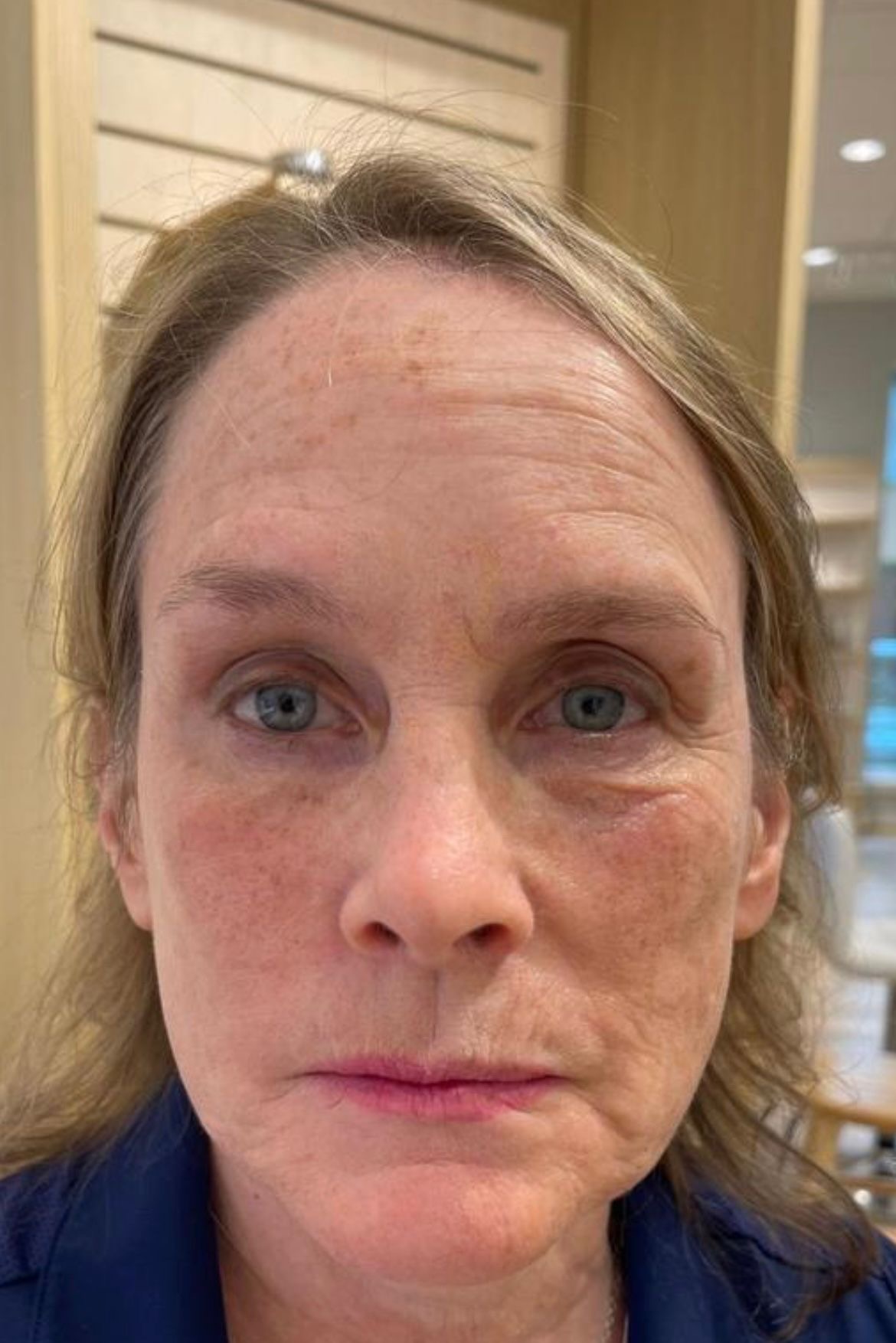 Skin rejuvenation result