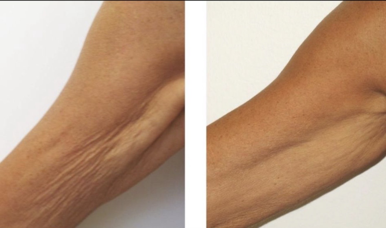 Arm skin tightening before and after